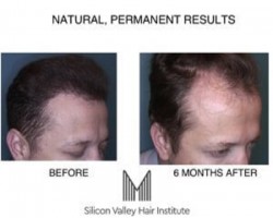 Silicon Valley Hair Institute, the Bay Area Leader in Hair Transplantation, Announces New Post on Thinning Hair and Its Treatment