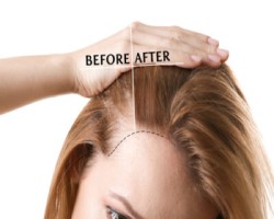 Best Hair Transplantation Clinic in Coimbatore